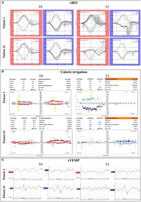 Long-Term Vestibular Outcomes in Cochlear Implant Recipients